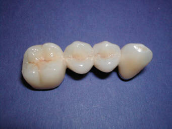 ceramique dentaire